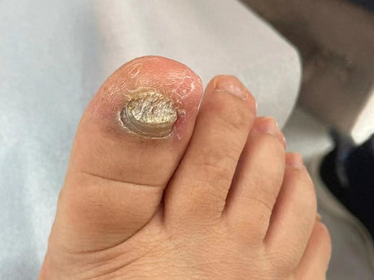 Herb Powder for Nail Fungus